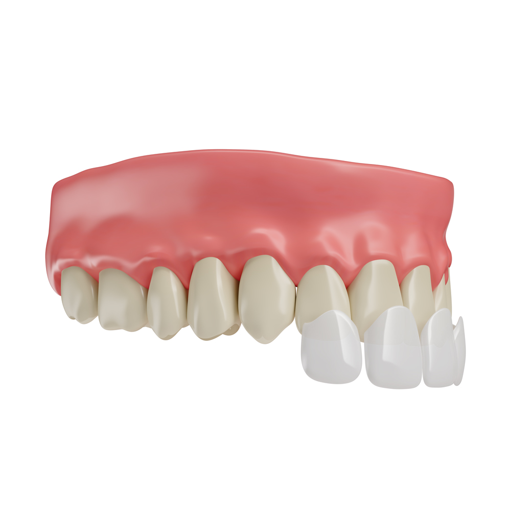 Custom dental veneers and crowns fitted on upper teeth
