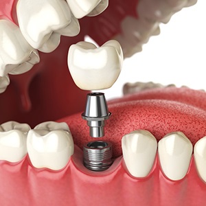 Dental implant with crown being placed into the jaw