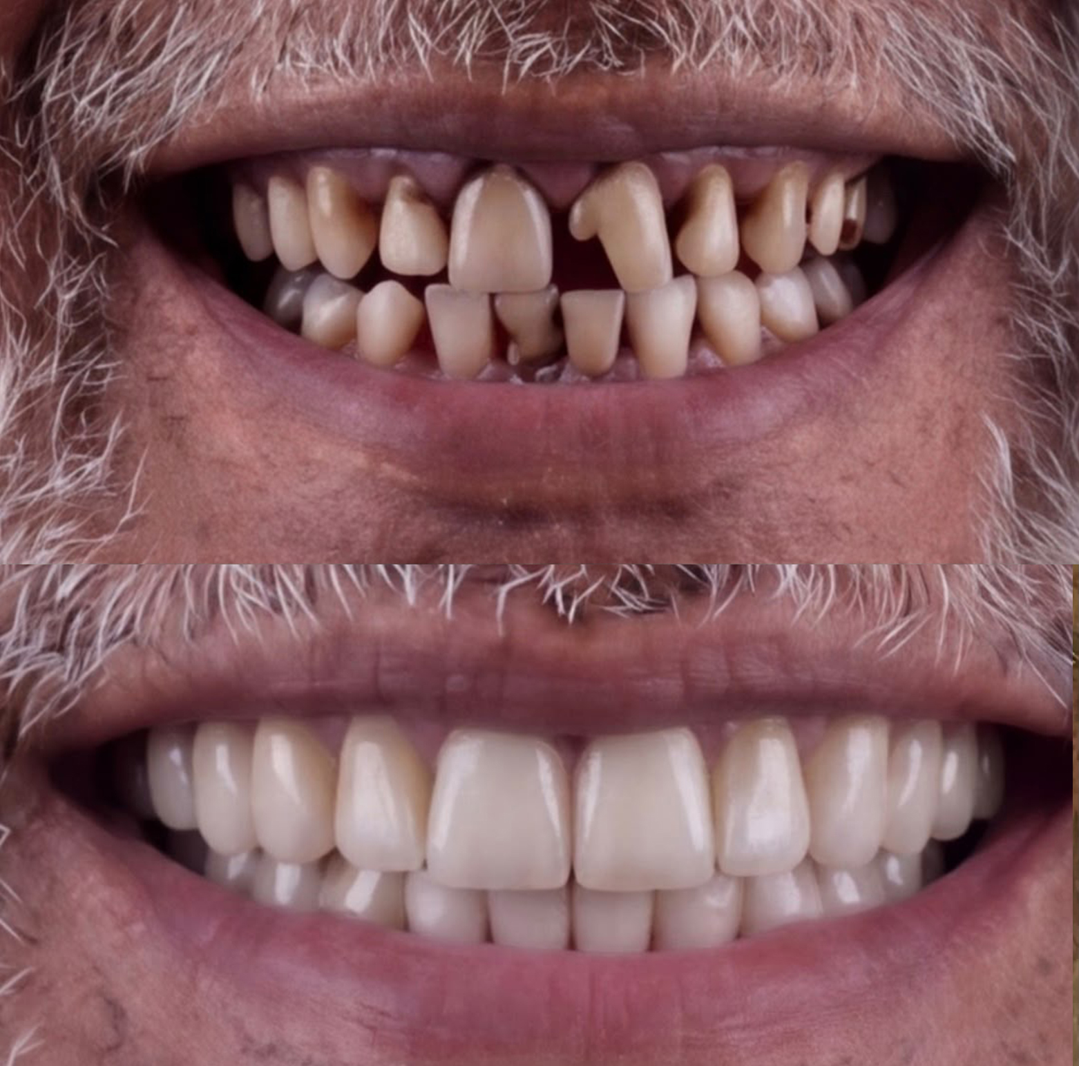 Full-arch restoration before and after
