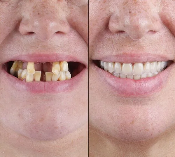 Dentica clinical team performing full mouth rehabilitation treatment