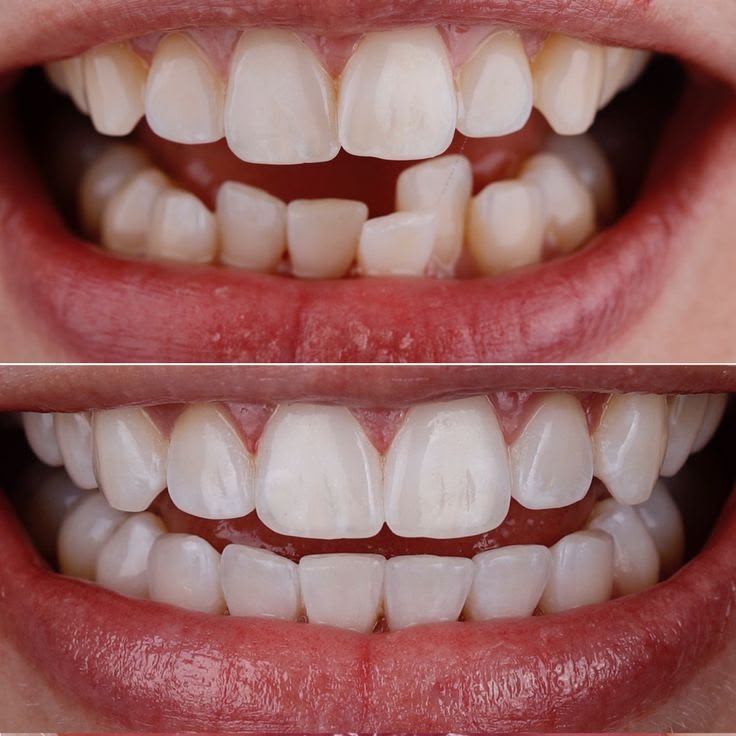 Veneers before and after comparison