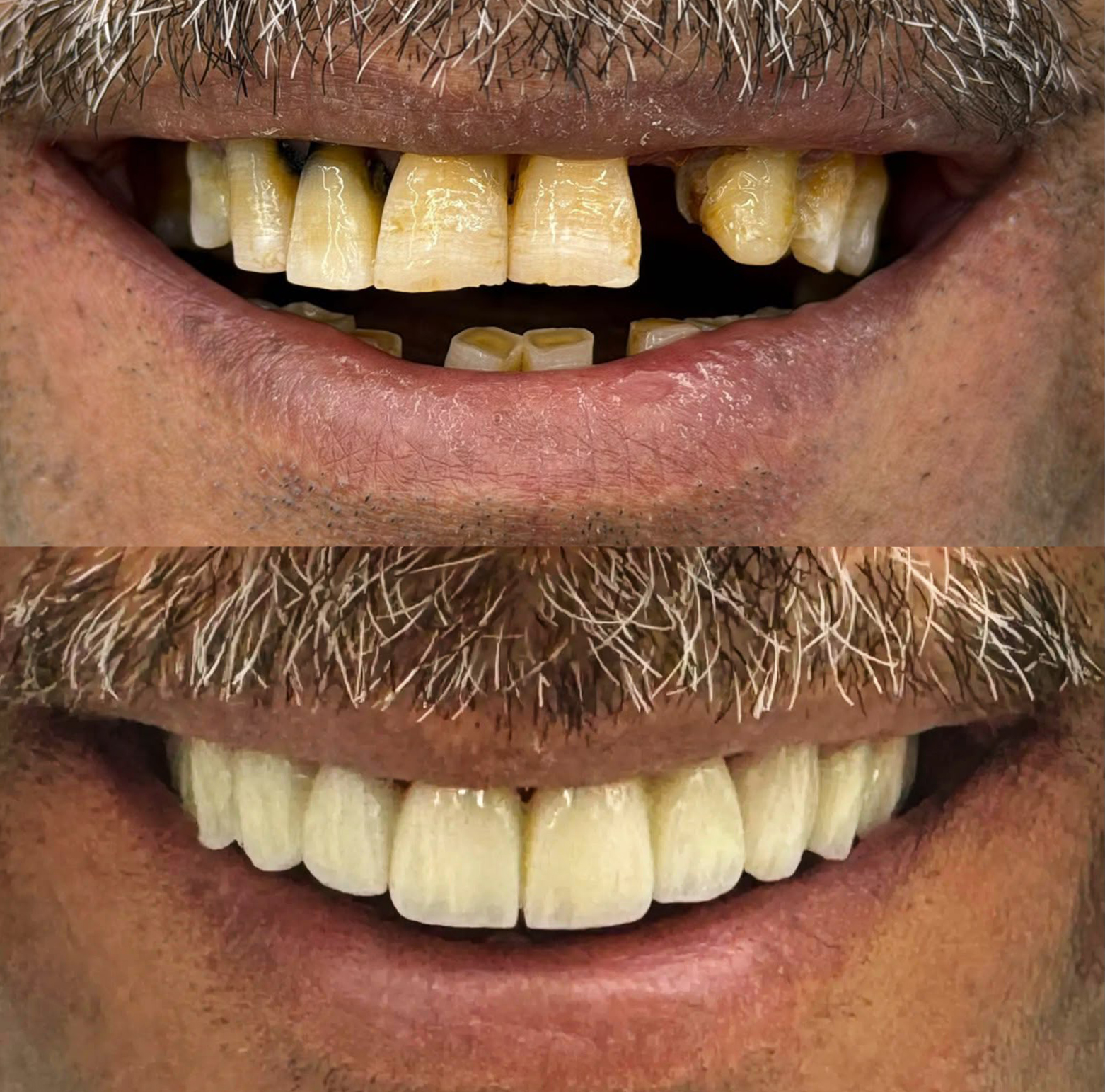 Teeth before and after full mouth rehabilitation