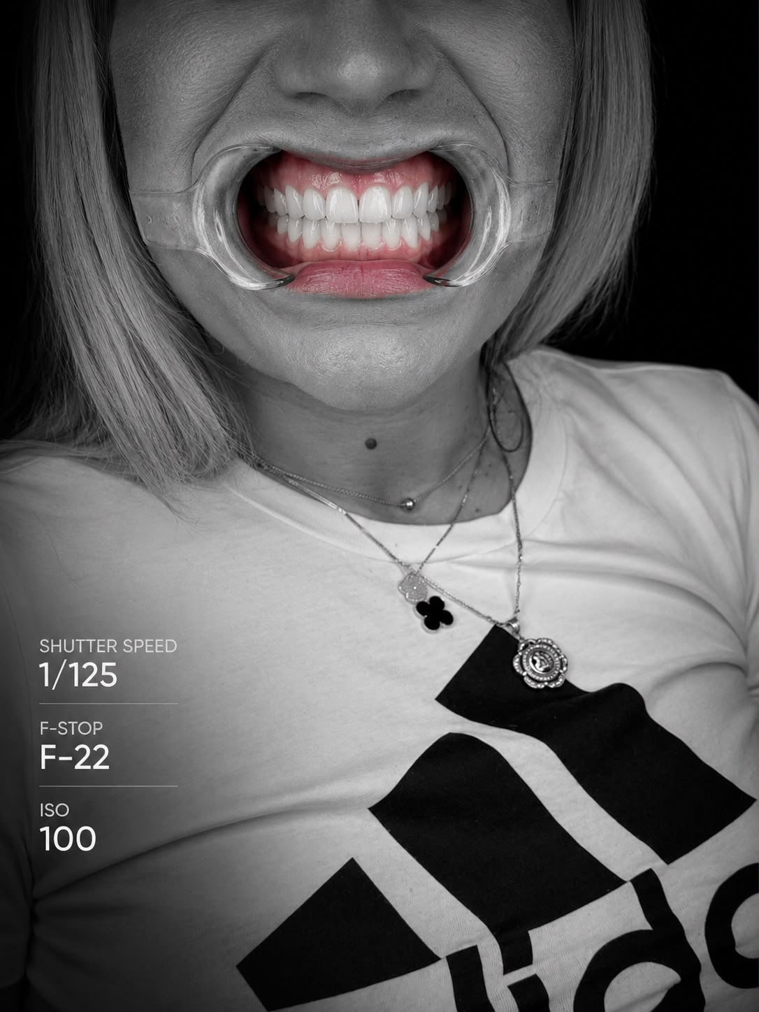 Restored smile with cheek retractor, clinical photo