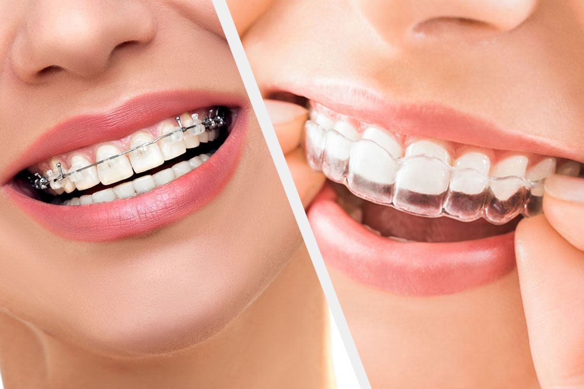 Comparison of ceramic braces and clear invisible aligners