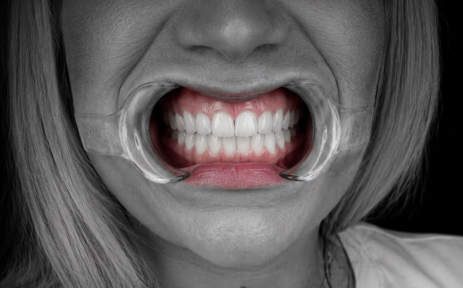 Restored upper arch with cheek retractors, clinical view